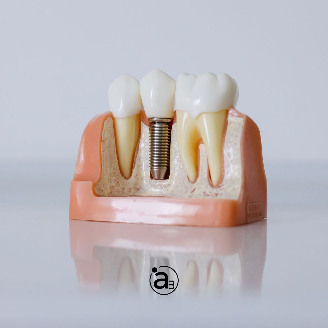 implantes_dentales