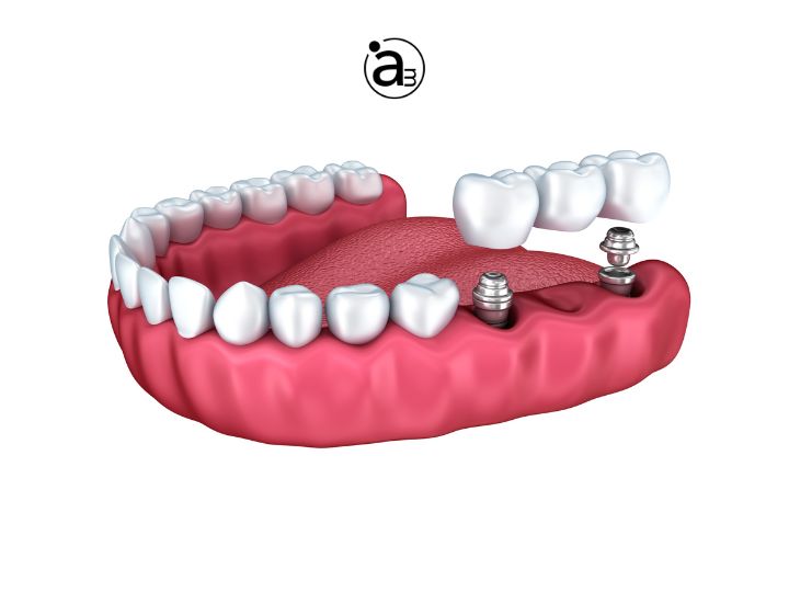 implantes-dentales-como-solucion-perdida-dientes