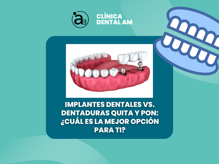 implantes dentales dentaduras